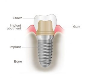 Dental Implant in Dubai