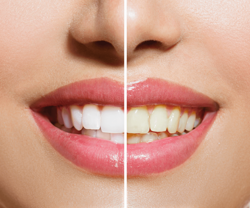 Teeth Whitening in Dubai Bissan Dental Center