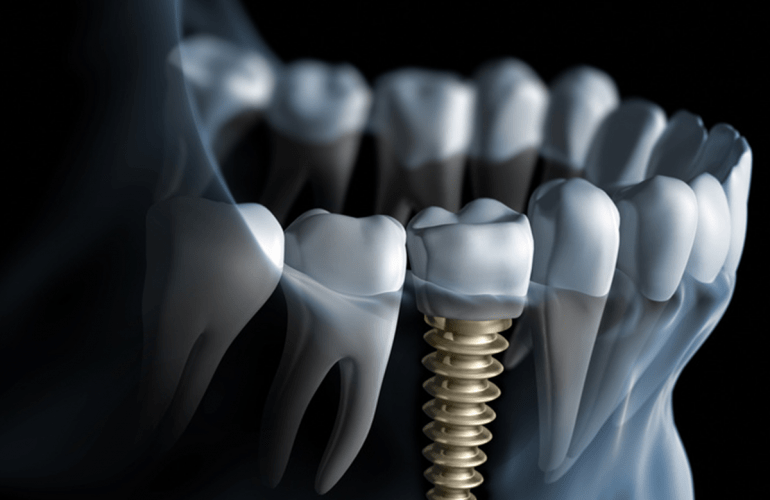 Dental Implant in Dubai