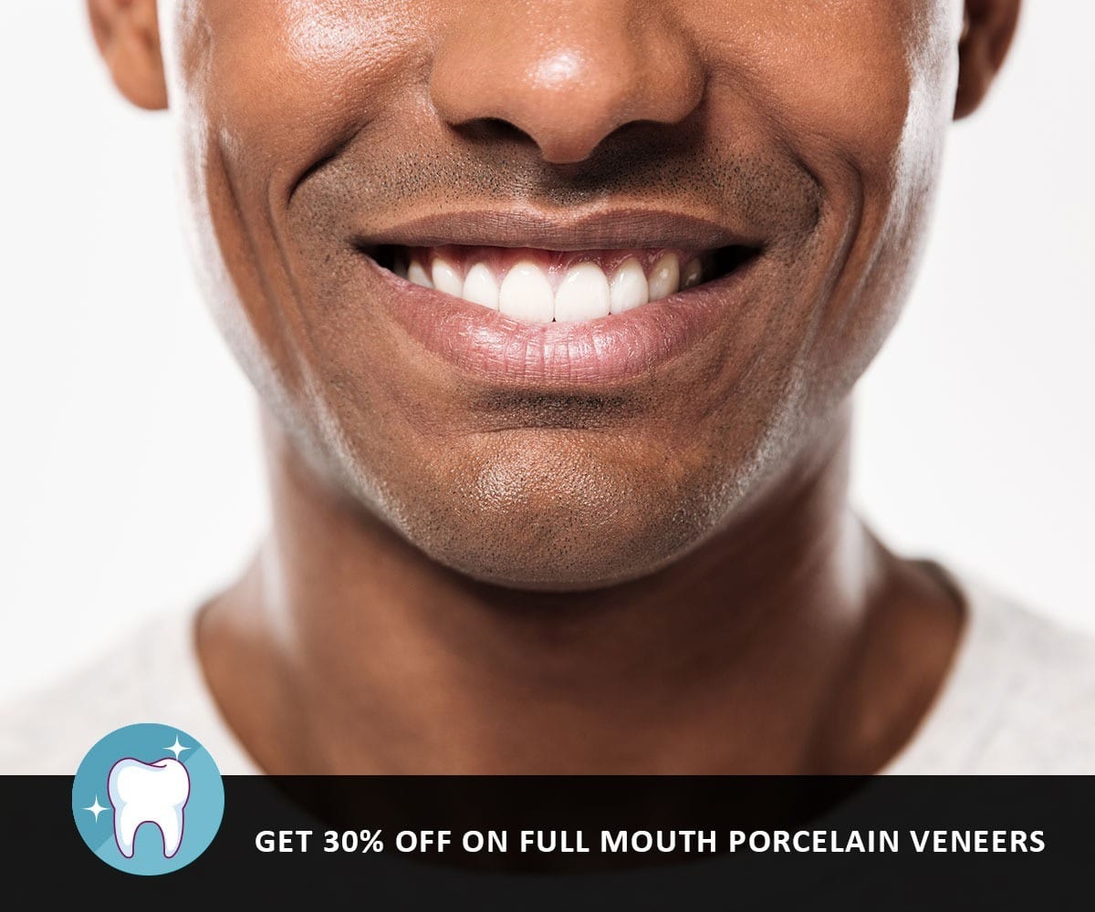 Veneers