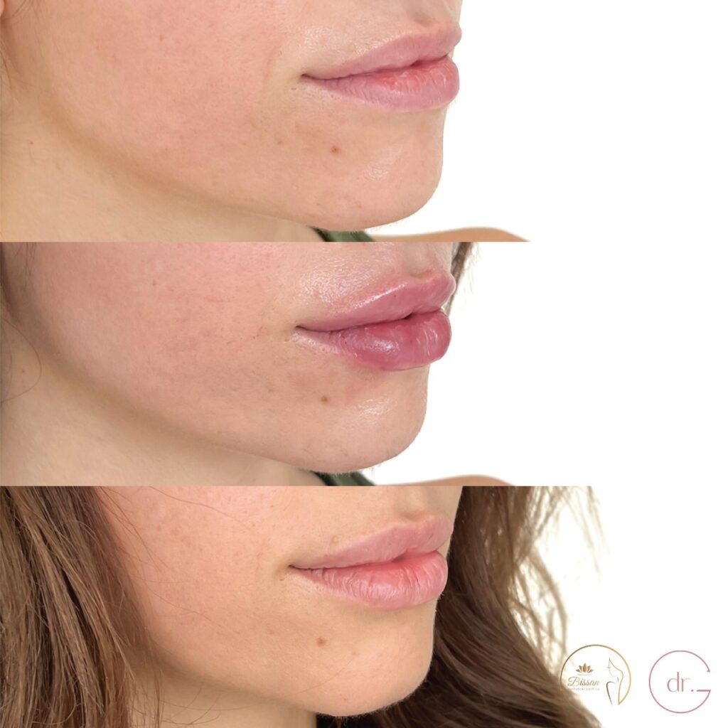 Lip Fillers Clinic in Dubai Bissan Dental Center