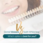 Dental Veneers Vs Teeth Whitening?