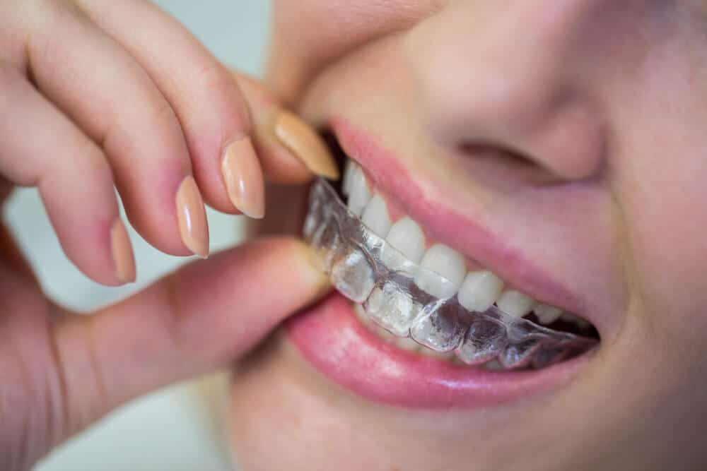 orthodontic teeth alignment treatments