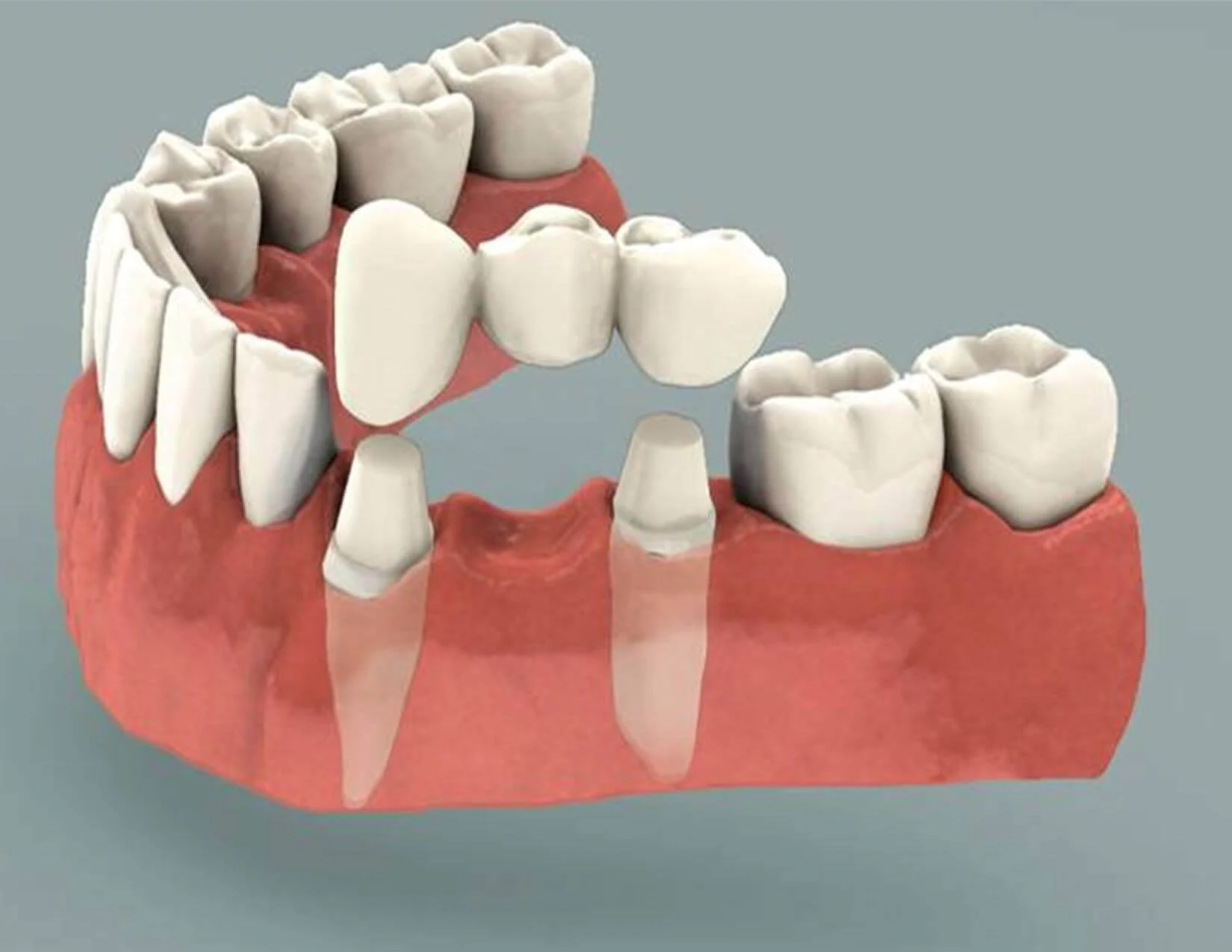 Dental Bridges