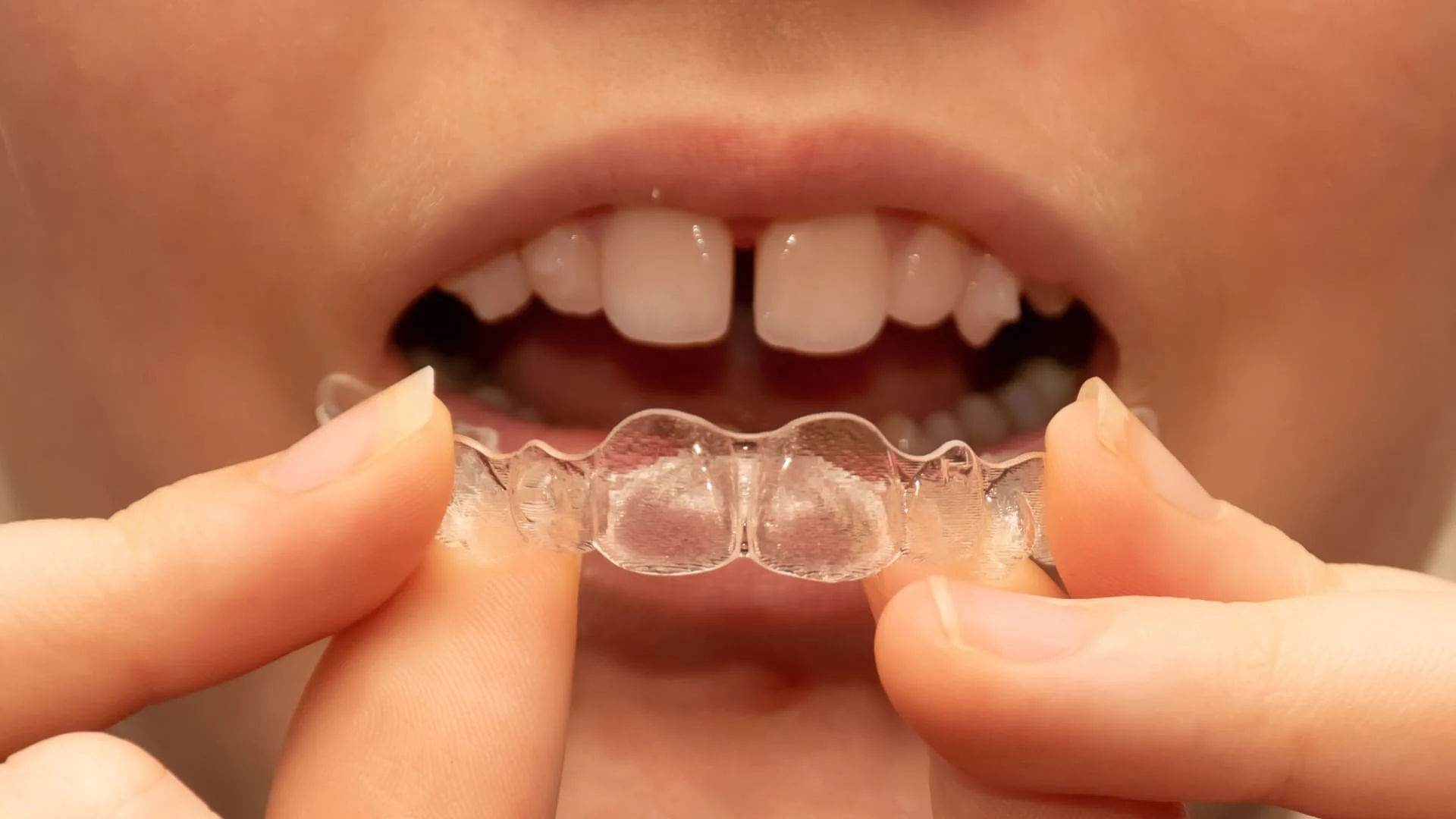Invisalign Dubai