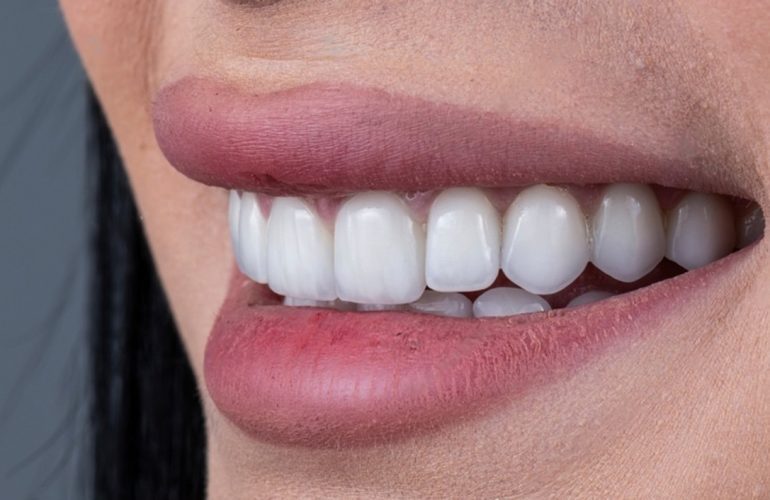 dental veneers
