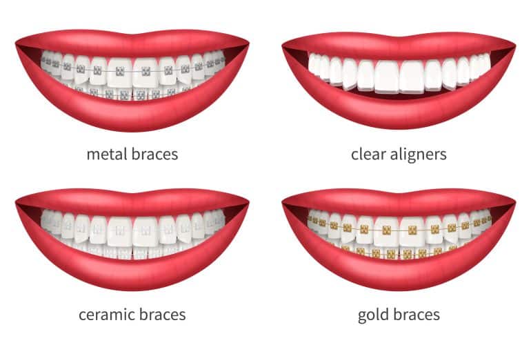 Orthodontic treatment in Dubai