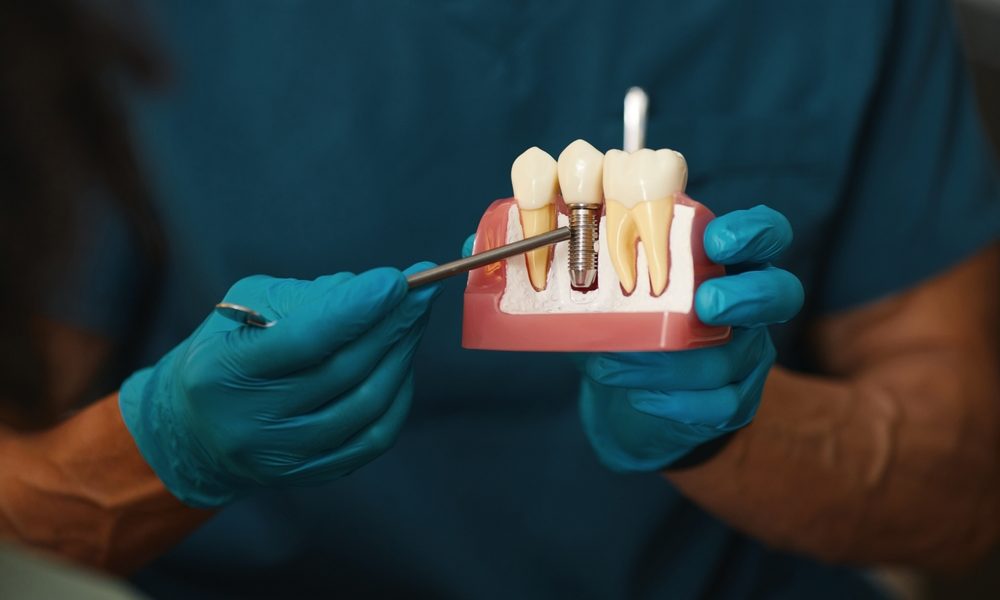 Dental implants in Dubai