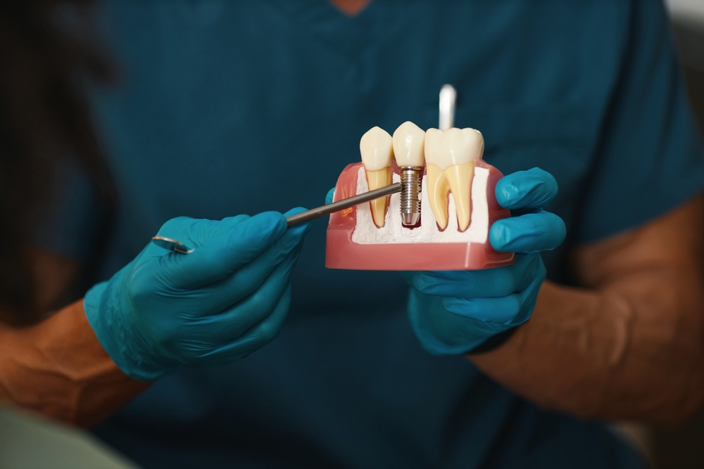 Dental implants in Dubai