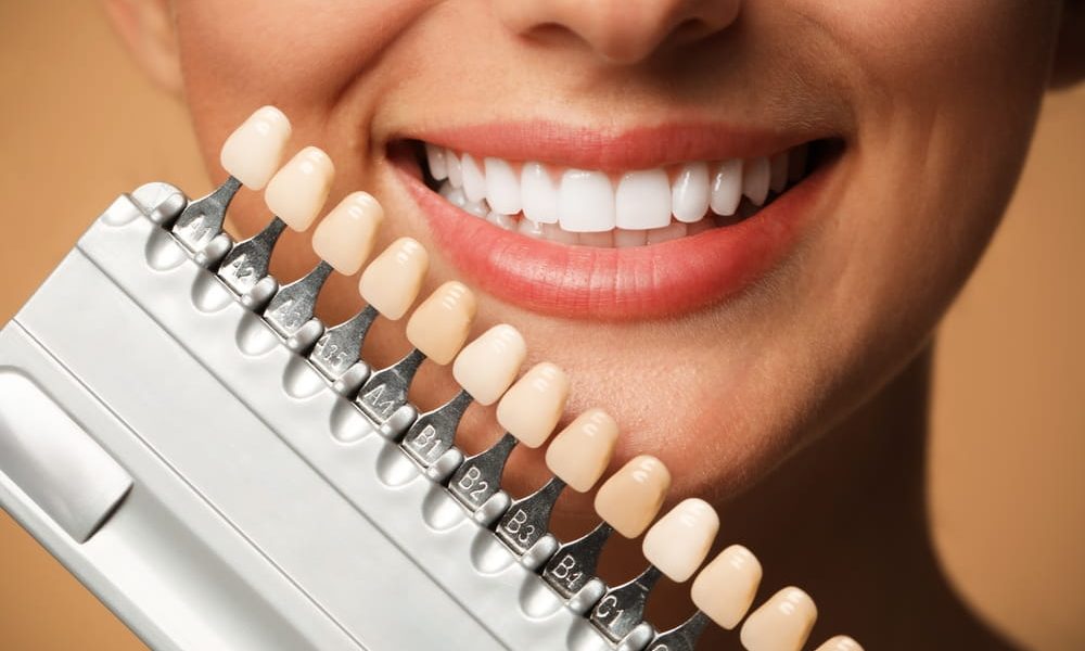 veneers cost Dubai